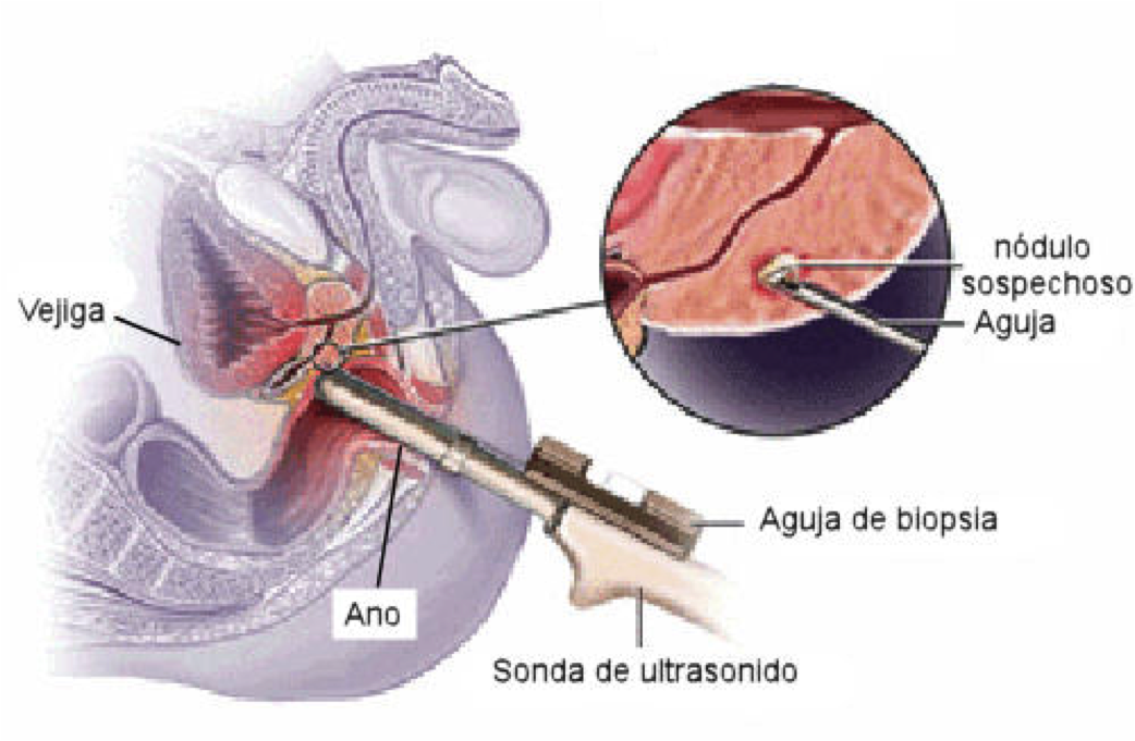 biopsia transrectal de próstata