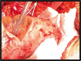 Tumorectomía parcial abierta