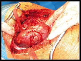 Tumorectomía parcial abierta