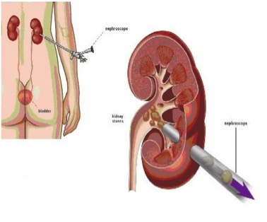 Cirugia renal percutánea