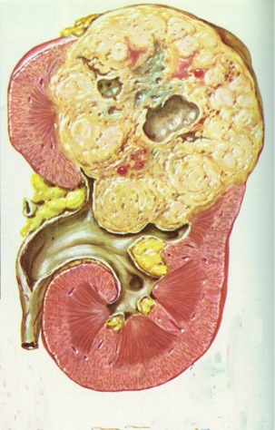 Carcinoma renal