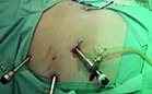 Tumorectomía parcial laparoscópica
