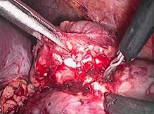 Tumorectomía parcial por laparoscopía