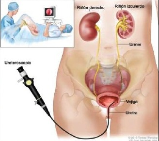 Ureteroscopia